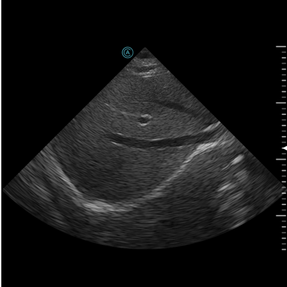 View of the liver using the neo P42 Wireless Handheld Ultrasound System